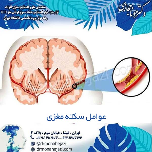 عوامل سکته مغزی