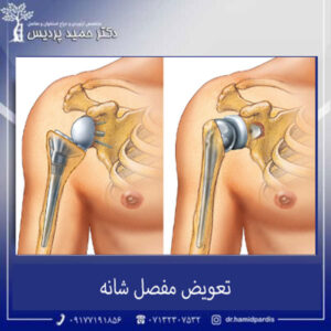 تعویض مفصل شانه - دکتر مونا حجازی