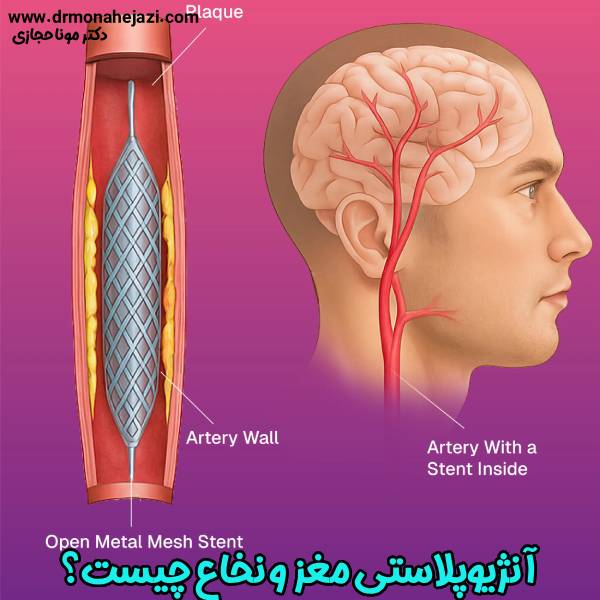 عکس آنژیوپلاستی مغز و نخاع - دکتر مونا حجازی