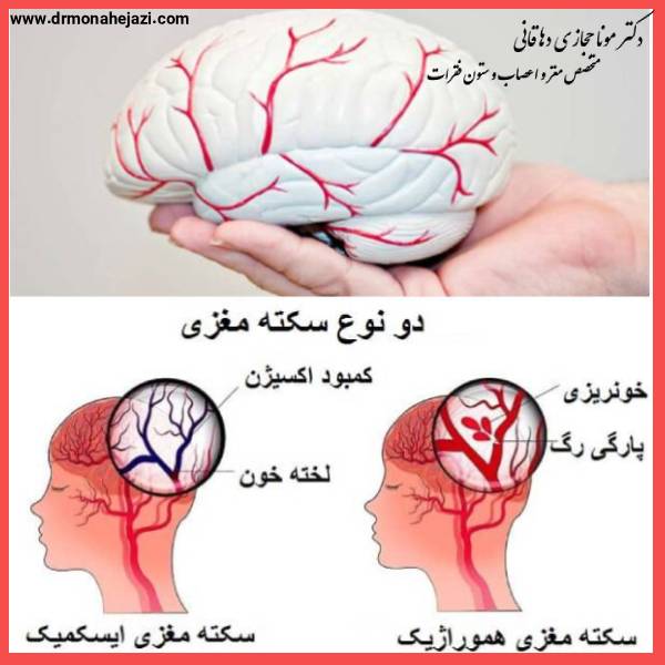 سکته حفیف مغزی TIA - دکتر مونا حجازی
