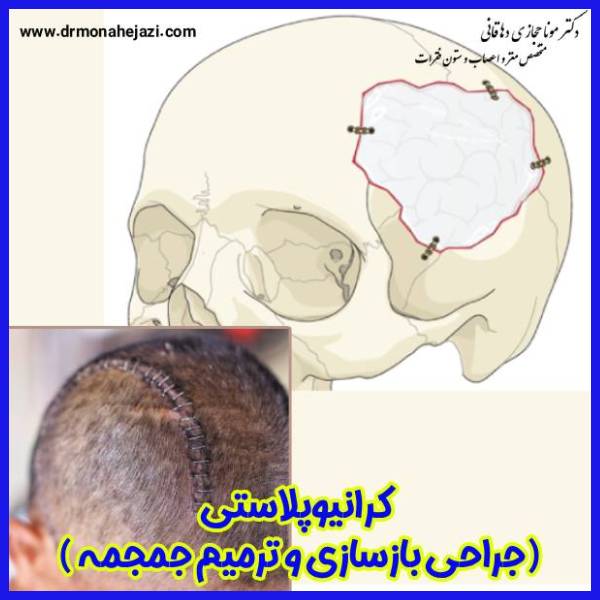 کرانیوپلاستی - دکتر مونا حجازی