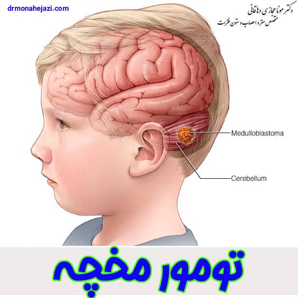 تومور مخچه - دکتر مونا حجاری