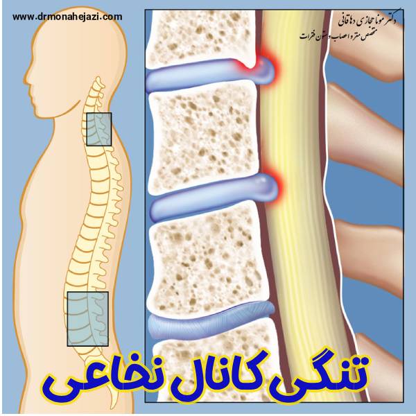 تنگی کانال نخاعی - دکتر مونا حجازی